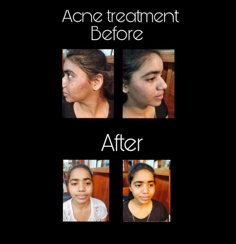 Acne Treatment — Before & After